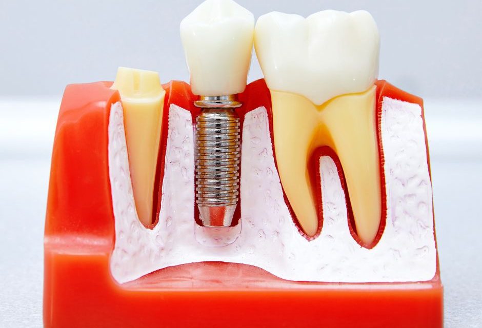 Implanty zębowe - najtrwalszy sposób uzupełniania brakujących zębów