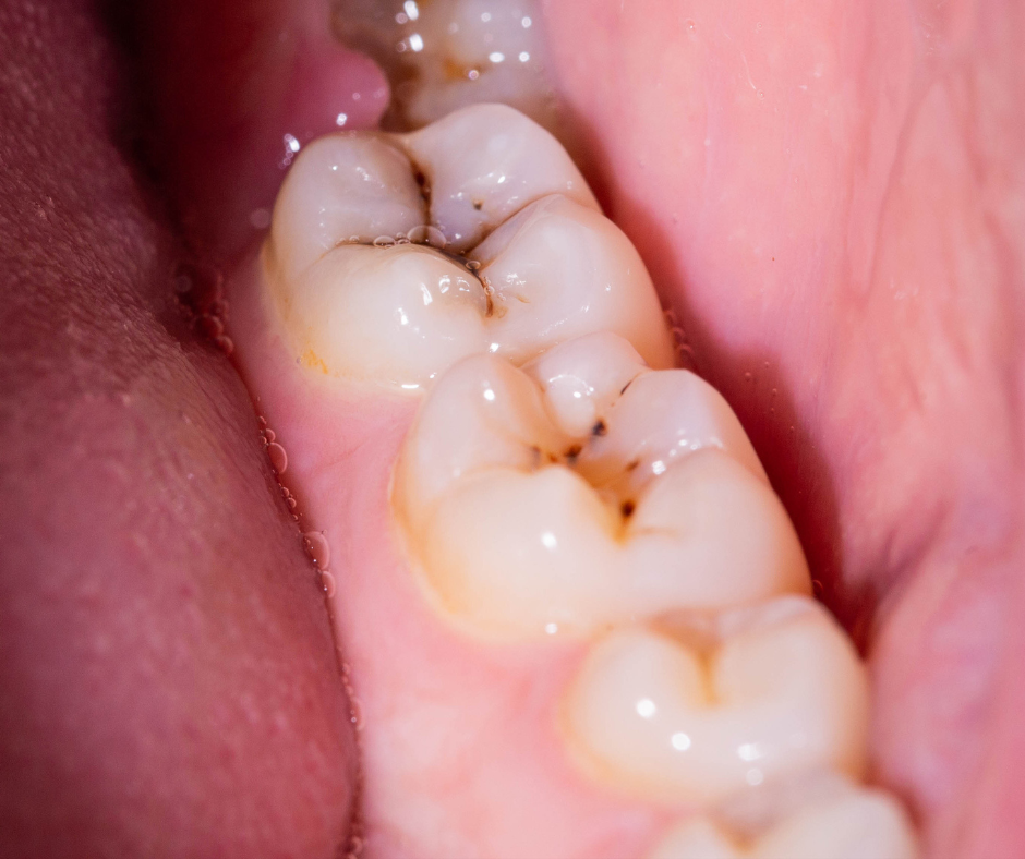 leczenie próchnicy zęba 